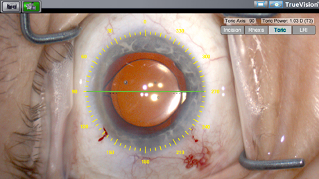 TrueGuide® technology from TrueVision adapted to provide surgical planning and guidance templates to Leica Microsystems’ ophthalmic microscopes during cataract and refractive surgery.Photo by Leica Microsystems GmbH